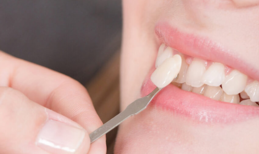 What Is Dental Veneer, And What Are Its Benefits?